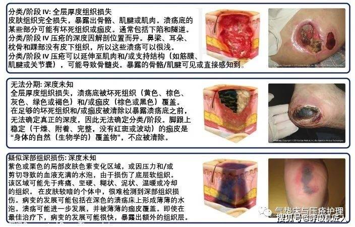 最新压疮分期及护理，科技与生活的无缝对接实践