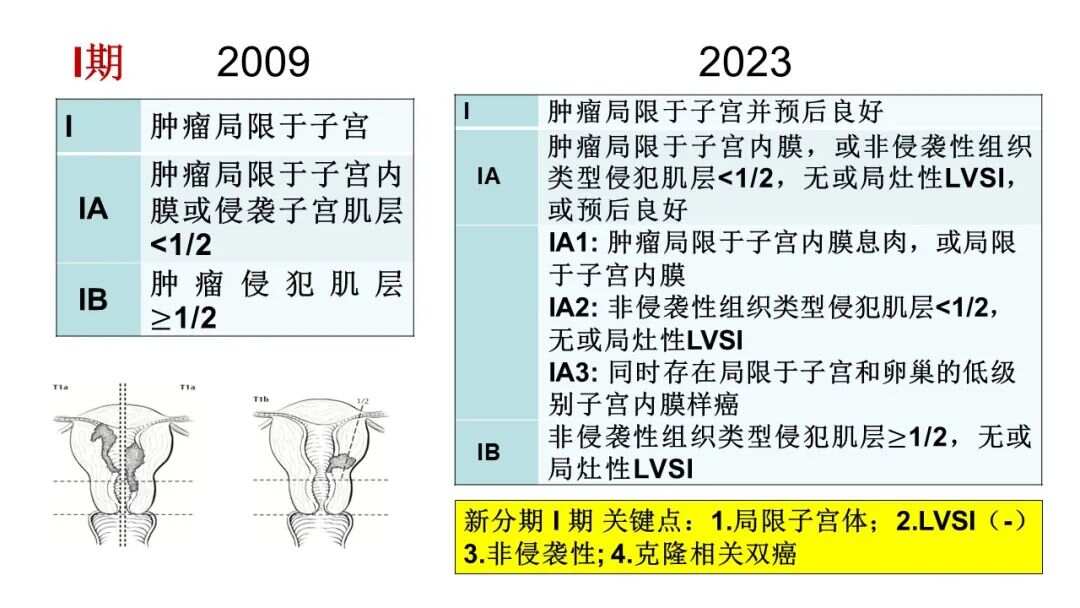 子宫内膜癌最新分期，探索隐秘宝藏的分期之旅